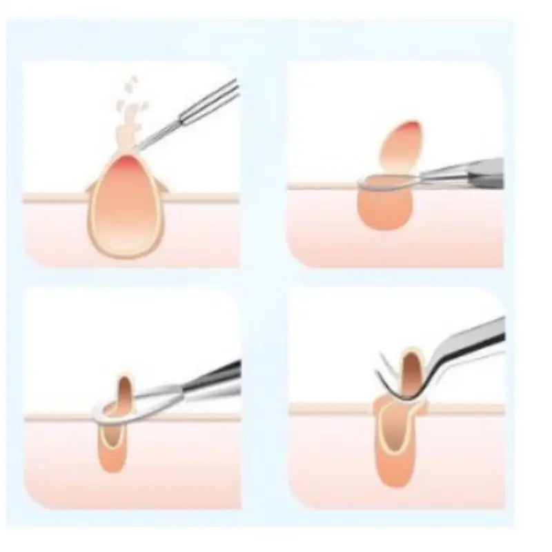Kit Extrator de Acne Profissional – 4 Peças em Aço Inoxidável